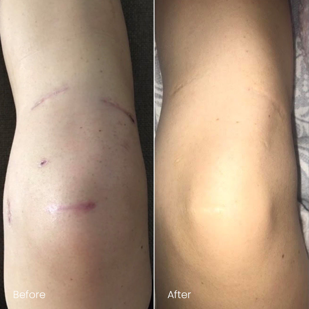 Incredible for Scar Healing!