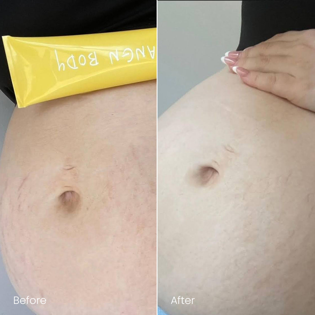 This product significantly reduced my stretchmarks during pregnancy!